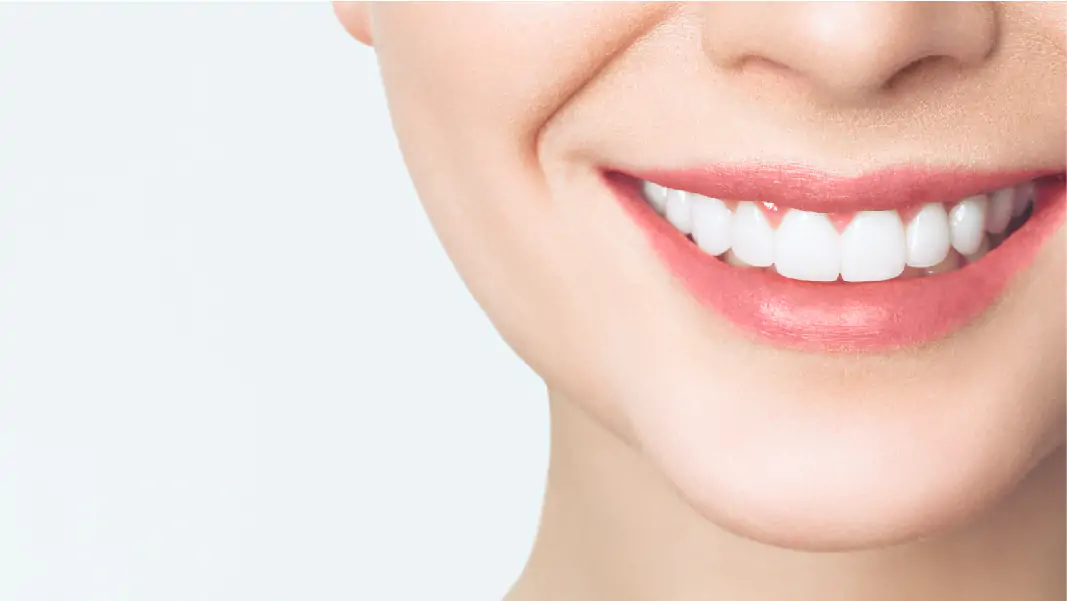 Denti laminati