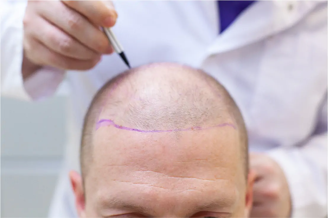 Technique FUE Transplantation de cheveux