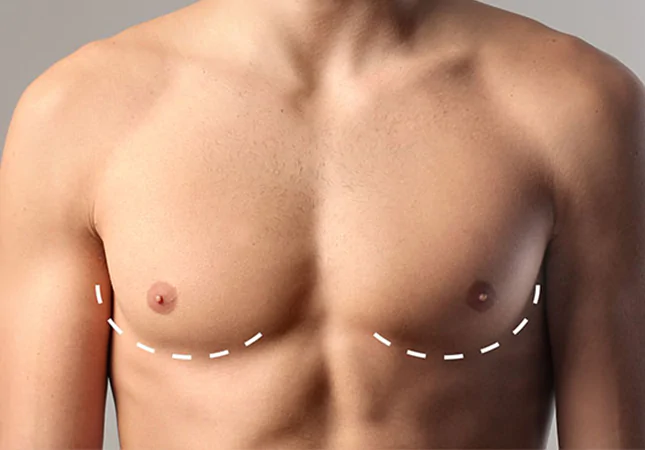 Gynécomastie Réduction mammaire Liposuccion