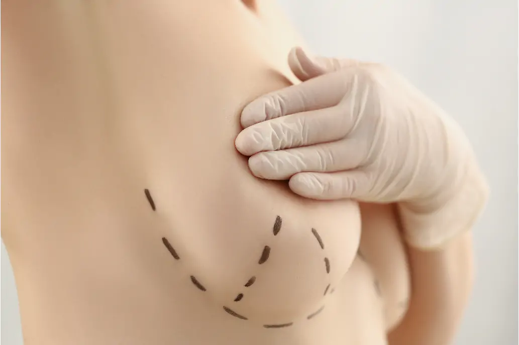 Lifting des seins