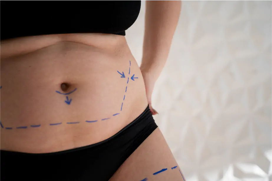 Lifting abdominal + Vaser
