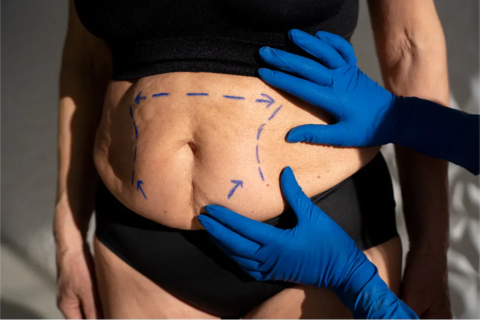 Liposuccion abdominale et de la taille + Vaser